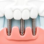 dental implants hungary helvetic clinics